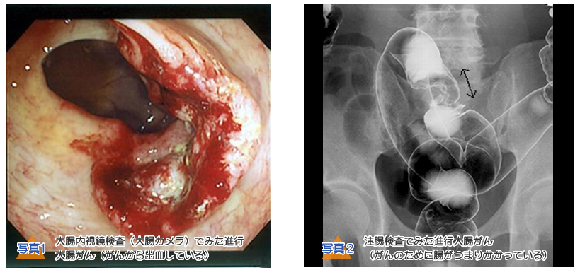 写真1 大腸内視鏡検査（大腸カメラ）でみた進行大腸がん（がんから出血している写真2注腸検査でみた進行大腸がん（がんのために腸がつまりかかっている）