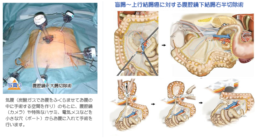 腸 の 癒着 手術