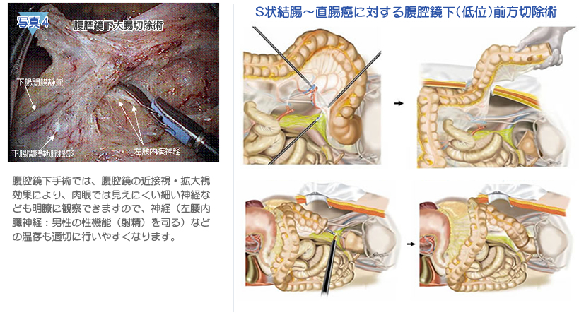 写真4 腹腔鏡下大腸切除術腹腔鏡下手術では、腹腔鏡の近接視・拡大視効果により、肉眼では見えにくい細い神経なども明瞭に観察できますので、神経（左腰内臓神経：男性の性機能（射精）を司る）などの温存も適切に行いやすくなります。