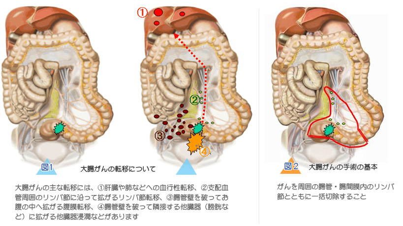 図1 大腸がんの転移について大腸がんの主な転移には、①肝臓や肺などへの血行性転移、②支配血管周囲のリンパ節に沿って拡がるリンパ節転移、③腸管壁を破ってお腹の中へ拡がる腹膜転移、④腸管壁を破って隣接する他臓器（膀胱など）に拡がる他臓器浸潤などがあります 図2 大腸がんの手術の基本がんを周囲の腸管・腸間膜内のリンパ節とともに一括切除すること 